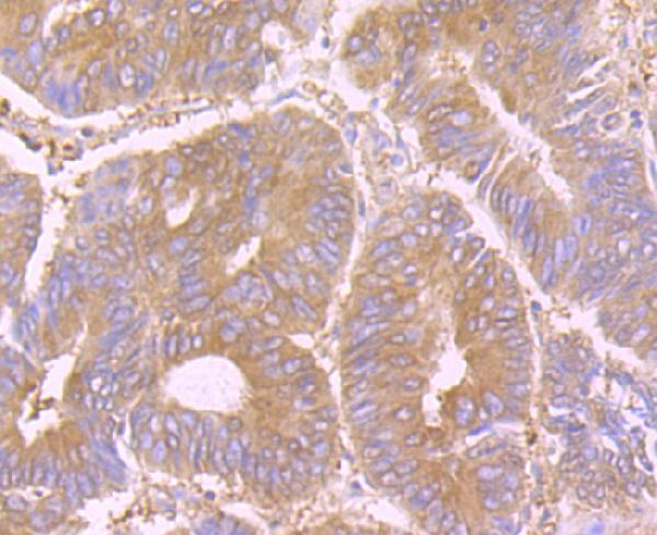 Immunohistochemical analysis of paraffin-embedded human colon cancer tissue using anti-STIP1 antibody