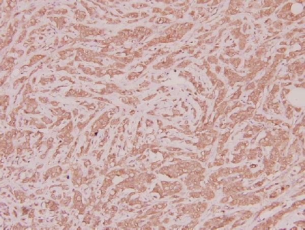 Immunohistochemistry (IHC) analyzes of CLN1 (I65) pAb in paraffin-embedded human breast carcinoma tissue at 1:100