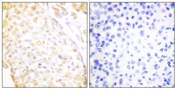 Immunohistochemistry analysis of paraffin-embedded human breast carcinoma, using NKX3