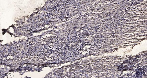 Immunohistochemical analysis of paraffin-embedded human liver cancer