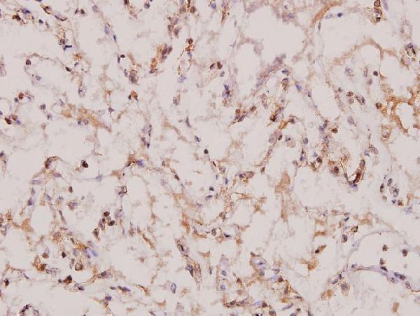 Immunohistochemistry (IHC) analyzes of Topo IIβ (A32) pAb in paraffin-embedded human lung carcinoma tissue at 1:100
