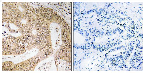 Immunohistochemistry analysis of paraffin-embedded human colon carcinoma tissue, using DAP Antibody