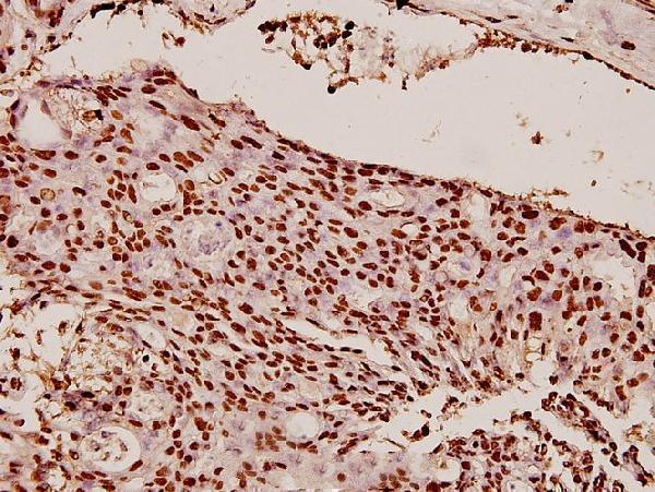 Immunohistochemistry (IHC) analyzes of CBX5 (K69) pAb in paraffin-embedded human breast carcinoma tissue at 1:100