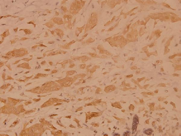 Immunohistochemistry (IHC) analyzes of TRADD (L282) pAb in paraffin-embedded human breast carcinoma tissue at 1:100