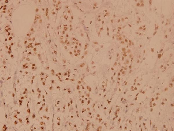 Immunohistochemistry (IHC) analyzes of PP1α (G315) pAb in paraffin-embedded human breast carcinoma tissue at 1:100