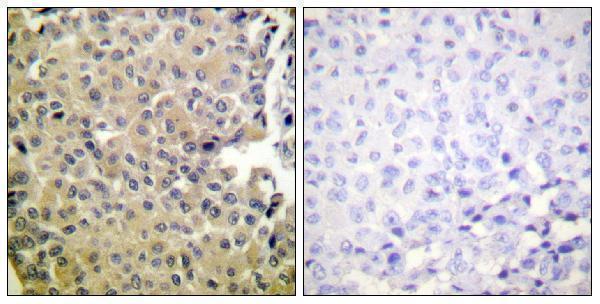Immunohistochemistry analysis of paraffin-embedded human breast carcinoma, using PP1-alpha (Phospho-Thr320) Antibody