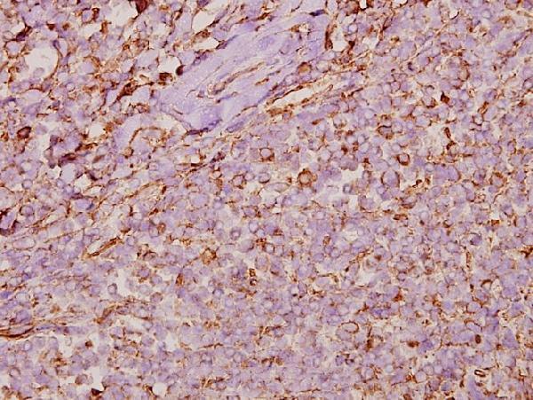 Immunohistochemistry (IHC) analyzes of Cyclophilin F (Y121) pAb in paraffin-embedded human tonsil carcinoma tissue at 1:50