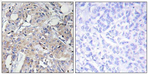 Immunohistochemistry analysis of paraffin-embedded human breast carcinoma tissue, using Collagen VI alpha3 Antibody