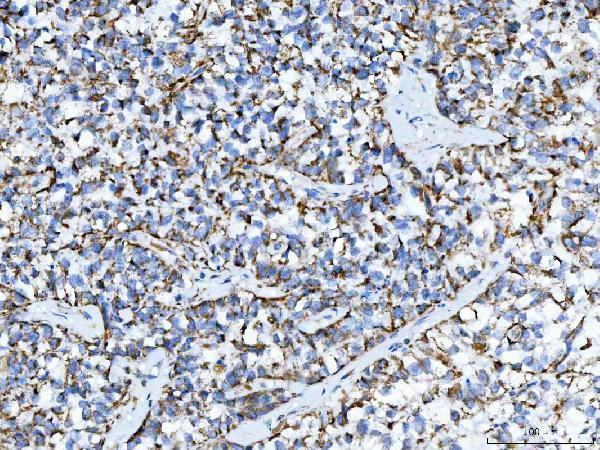  IHC analysis of TRK fused gene/TFG using anti-TRK fused gene/TFG antibody (A02870-3)