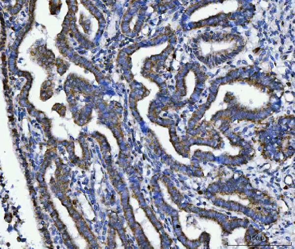  IHC analysis of TRK fused gene/TFG using anti-TRK fused gene/TFG antibody (A02870-3)