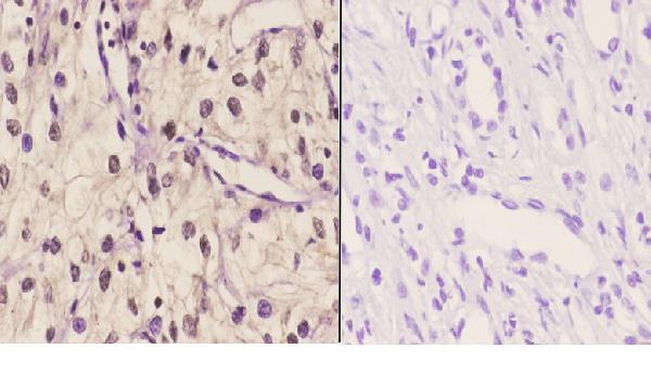 Immunohistochemistry (IHC) analyzes of TBX1 (K347) pAb in paraffin-embedded human kidney carcinoma tissue at 1:50