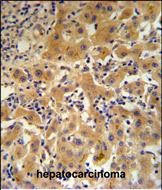 CP Antibody (N-term) IHC analysis in formalin fixed and paraffin embedded human hepatocarcinoma followed by peroxidase conjugation of the secondary antibody and DAB staining