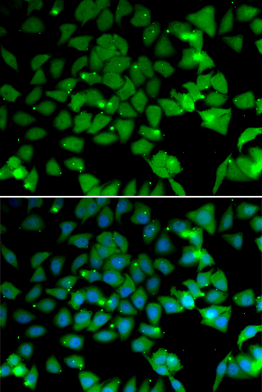 Immunohistochemistry of paraffin-embedded human breast cancer using NAA10 antibody  at dilution of 1:100 