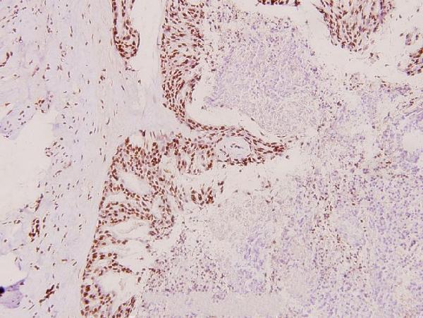 Immunohistochemistry (IHC) analyzes of hnRPD (H79) pAb in paraffin-embedded human breast carcinoma tissue at 1:100