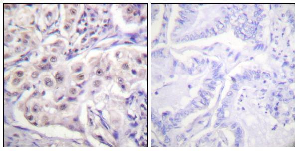 Immunohistochemistry analysis of paraffin-embedded human lung carcinoma tissue, using hnRPD Antibody