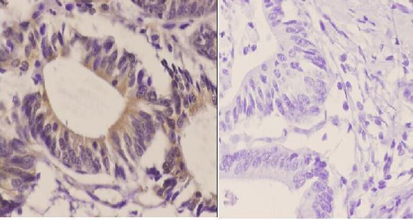 Immunohistochemistry (IHC) analyzes of GluR2 (Y873) pAb in paraffin-embedded human colon carcinoma tissue at 1:50