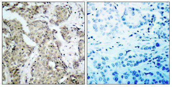 Immunohistochemistry analysis of paraffin-embedded human breast carcinoma, using MKK3 (Phospho-Ser189) Antibody