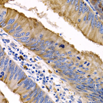 Immunohistochemistry of paraffin-embedded human colon cancer using IL9 antibody  at dilution of 1:200 