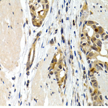 Immunohistochemistry of paraffin-embedded human stomach cancer using IL9 antibody  at dilution of 1:200 