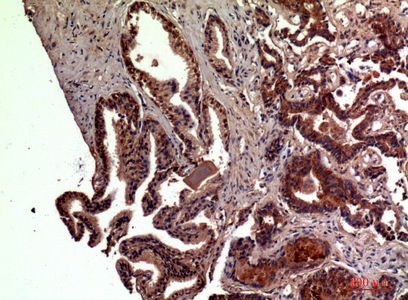 Immunohistochemical analysis of paraffin-embedded human-prostate-cancer, antibody was diluted at 1:100