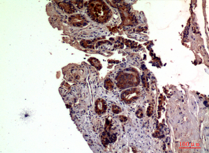 Immunohistochemical analysis of paraffin-embedded human-prostate-cancer, antibody was diluted at 1:100