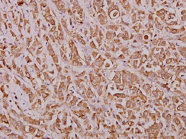Immunohistochemistry (IHC) analyzes of IRF-2 (K129) pAb in paraffin-embedded human breast carcinoma tissue at 1:100
