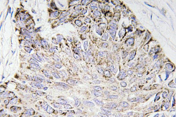 Immunohistochemistry analysis of Caspase-4 antibody in paraffin-embedded human lung carcinoma tissue