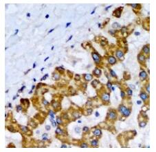 Immunohistochemical analysis of SCP2 staining in human liver cancer formalin fixed paraffin embedded tissue section