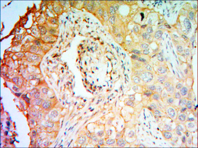 Immunohistochemistry analysis of paraffin-embedded lung cancer tissues with DAB staining using CCK-4 Monoclonal Antibody