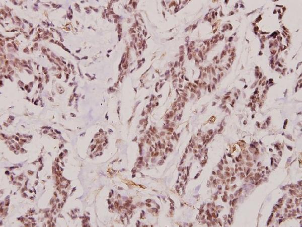 Immunohistochemistry (IHC) analyzes of IL-2Rβ (T360) pAb in paraffin-embedded human breast carcinoma tissue at 1:100