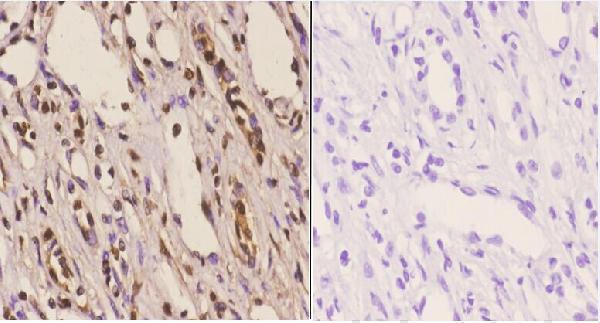 Immunohistochemistry (IHC) analyzes of ChemR23 (R249) pAb in paraffin-embedded human kidney carcinoma tissue at 1:50