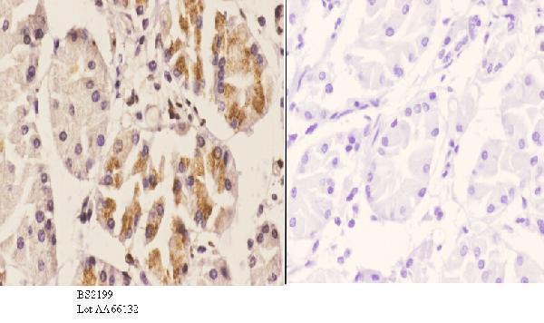 Immunohistochemistry (IHC) analyzes of ChemR23 (R249) pAb in paraffin-embedded human stomach carcinoma tissue at 1:50