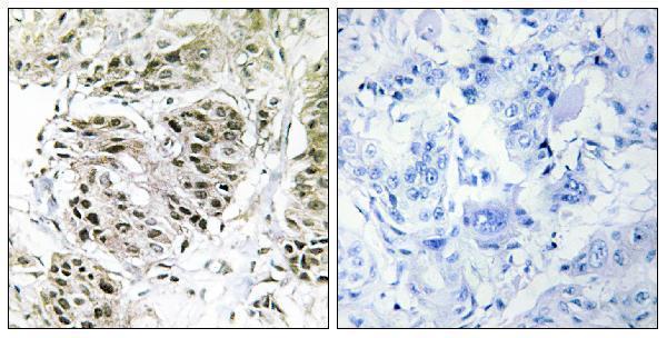 Immunohistochemistry analysis of paraffin-embedded human breast carcinoma, using CENPA Antibody