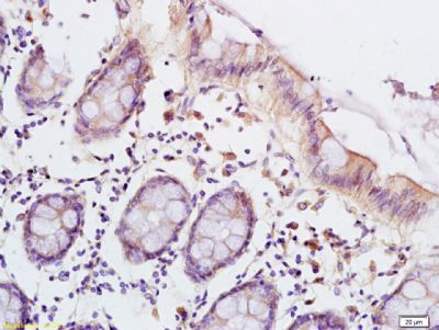 Tissue/cell: human colon carcinoma; 4% Paraformaldehyde-fixed and paraffin-embedded;
Antigen retrieval: citrate buffer ( 0