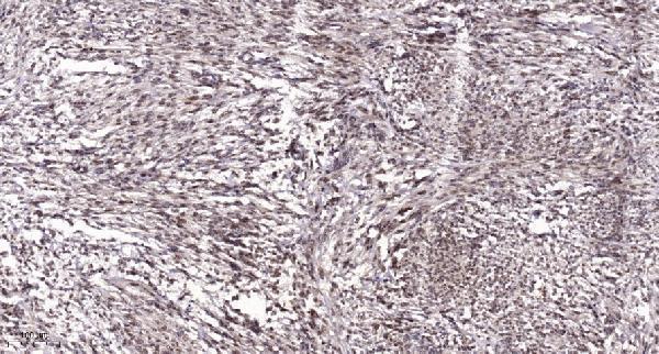 Immunohistochemical analysis of paraffin-embedded human Colon cancer