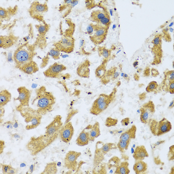 Immunohistochemistry of paraffin-embedded human liver cancer using BTD antibody  at dilution of 1:100 