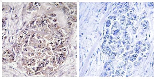 Immunohistochemistry analysis of paraffin-embedded human breast carcinoma tissue, using PEX1 Antibody