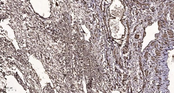 Immunohistochemical analysis of paraffin-embedded human oophoroma