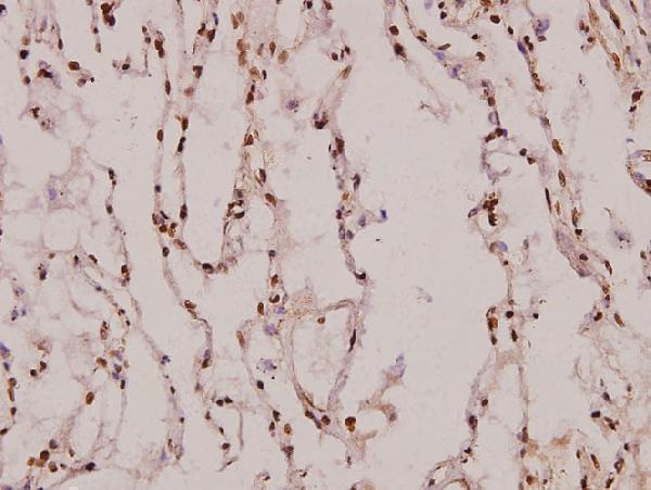 Immunohistochemistry (IHC) analyzes of AQP5 (Y243) pAb in paraffin-embedded human lung carcinoma tissue at 1:100