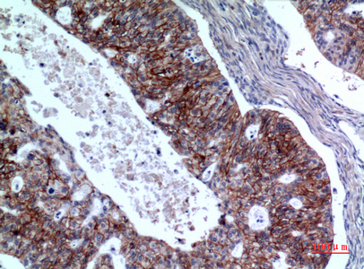 Immunohistochemical analysis of paraffin-embedded human-Ovarian-cancer, antibody was diluted at 1:100