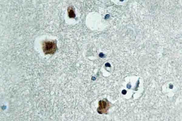 a03124 pak3 primary antiboties ihc testing 2