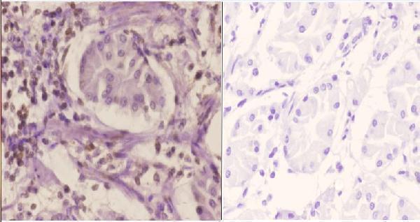 Immunohistochemistry (IHC) analyzes of SRp20 (F151) pAb in paraffin-embedded human stomach carcinoma tissue at 1:50