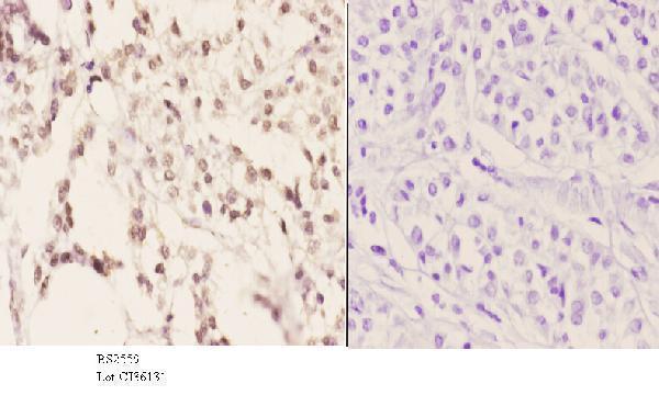 Immunohistochemistry (IHC) analyzes of SRp20 (F151) pAb in paraffin-embedded human liver carcinoma tissue at 1:50