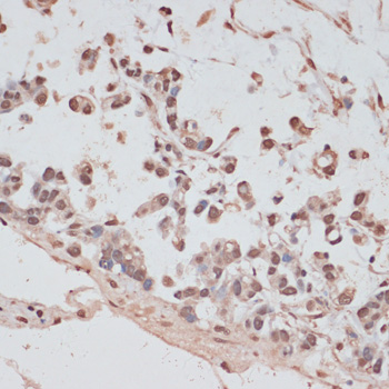Immunohistochemistry of paraffin-embedded human gastric cancer using PRPF31 antibody  at dilution of 1:100 