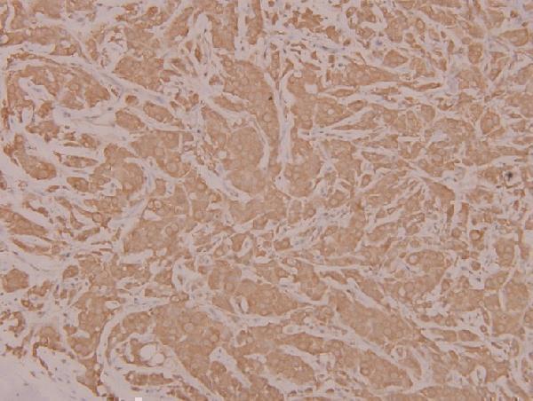 Immunohistochemistry (IHC) analyzes of HYD (T14) pAb in paraffin-embedded human breast carcinoma tissue at 1:100