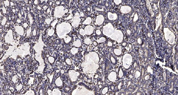 Immunohistochemical analysis of paraffin-embedded human Gastric adenocarcinoma