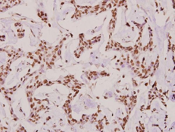 Immunohistochemistry (IHC) analyzes of COL6A2 (Y711) pAb in paraffin-embedded human breast carcinoma tissue at 1:100