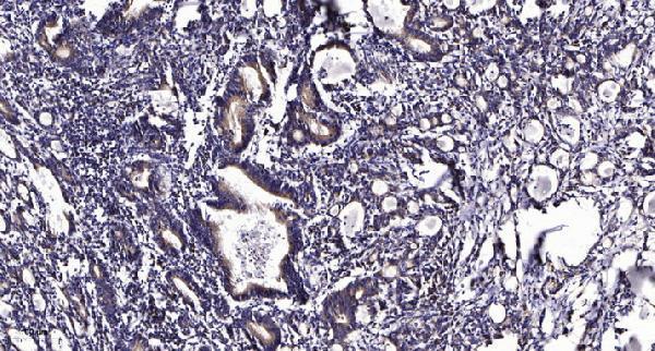 Immunohistochemical analysis of paraffin-embedded human Gastric adenocarcinoma