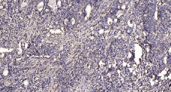 Immunohistochemical analysis of paraffin-embedded human Gastric adenocarcinoma