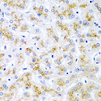 Immunohistochemistry of paraffin-embedded human liver damage using WNT2 antibody  at dilution of 1:200 